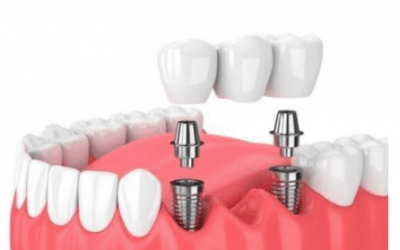 Implantes dentales