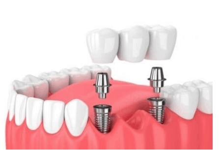 implantes dentales blasmaxilo