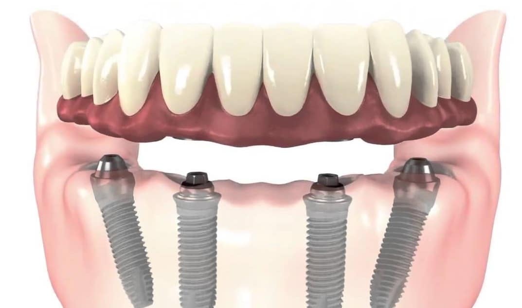 Implantes dentales angulados