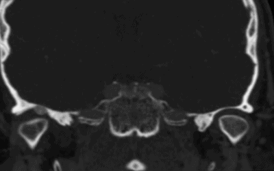 Sinovitis Vellonodular Pigmentada