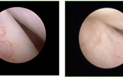 Eminoplastia artroscópica de la articulación temporomandibular: técnica quirúrgica