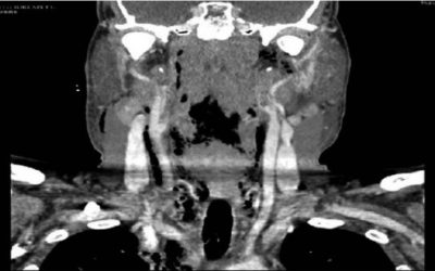 Casos de Fascitis necrotizante cervical y mediastinitis aguda de origen odontogénico